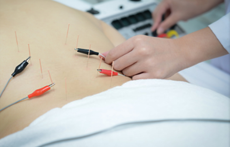 Điện mãng châm điều trị đau lưng (Yêu thống)